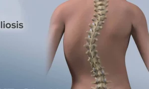 Scoliosis Management Through Exercise – Part 2: Strengthening and Alignment Techniques